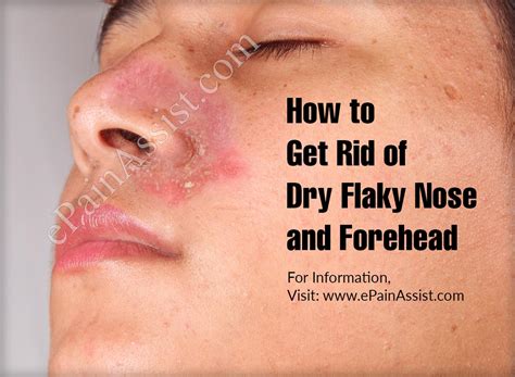 Get Rid Of Dry Flaky Nose And Forehead With These Effective Ways And Home