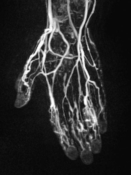 Compva Venous Malformation Of The Forearm And Hand