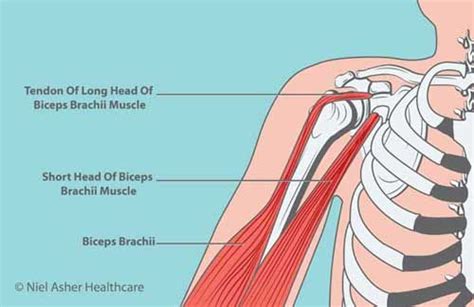 Biceps Tendinopathy Causes Symptoms Treatment And Pro