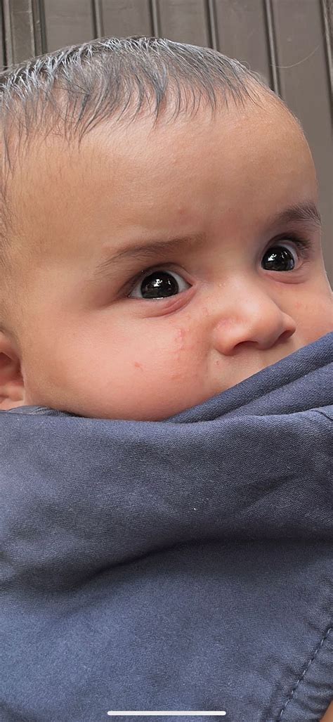 Bumpspimplesrash On Babys Face Help Babycenter