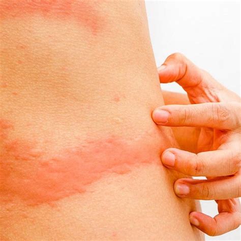 Types Of Skin Rashes In Adults
