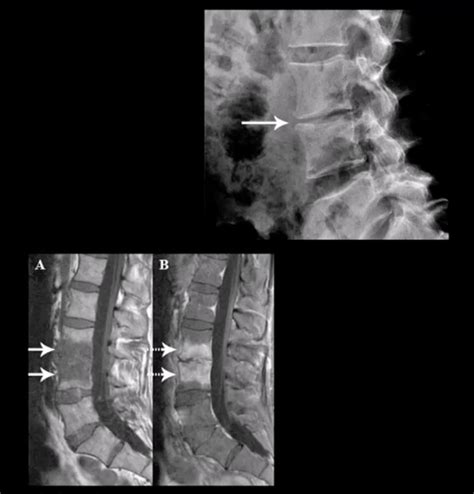 Discitis Spinal Disc Infection Causing Inflammation