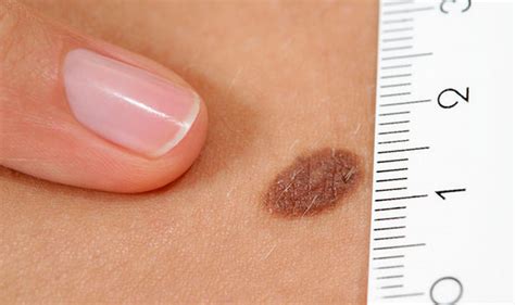 Skin Cancer Symptoms How To Tell The Difference Between Cancerous And