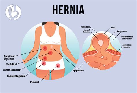 Umbilical Hernia After Pregnancy Beyondfit Mom