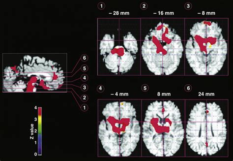 Neuroimaging Techniques Neupsy Key