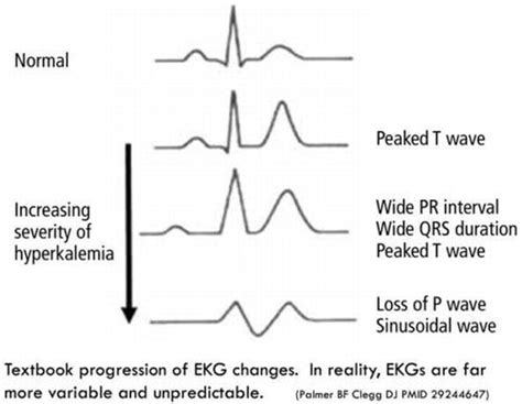 Ekg 1 Ekg Pattern Showing Changes In Hyperkalemia