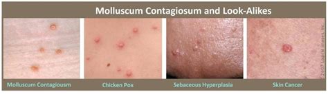 Molluscum Contagiosum Symptoms And Treatment Dermatol