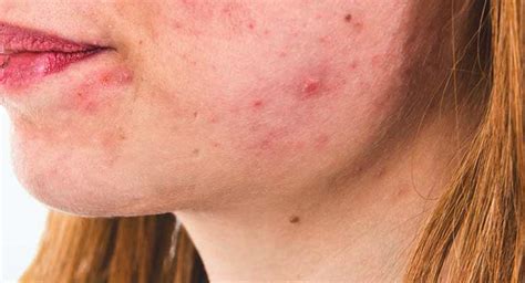 Accutane Side Effects What Are They