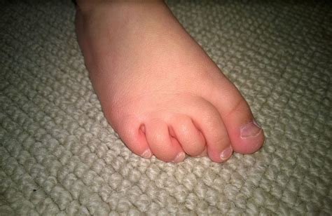All About Toes Curly Extra Webbed Toes Watsonia Podiatry