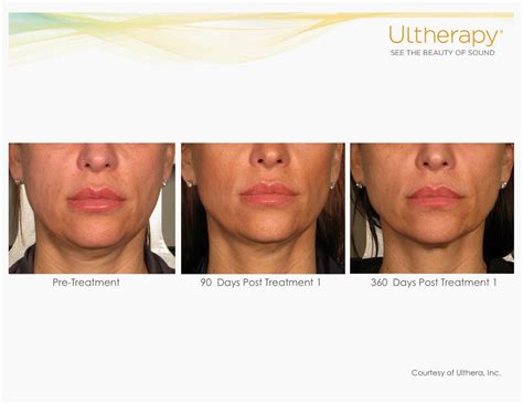 Dr Visha Blog Ultherapy The Non Surgical Skin Tightening Solution