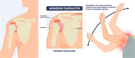 Frozen Shoulder Diagnosis And Treatment Dr Chris Jones