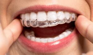 But how long must you wear a retainer? Dr. Gina Lee's Helpful Hacks: Retainers - Keeping You in ...