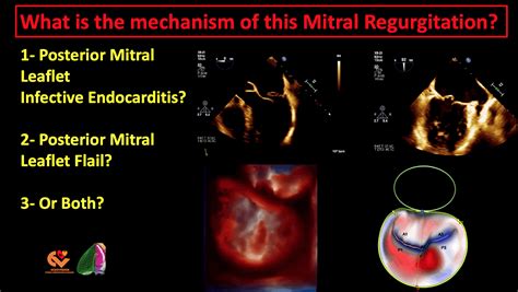 Mitral Regurgitation What Is The Mechanism Echovision