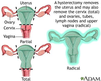 Hysterectomy Abdominal Discharge Multimedia Encyclopedia Health