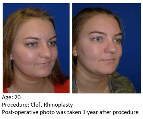 Cleft Rhinoplasty Uf Health Plastic Surgery And Aesthetics Center