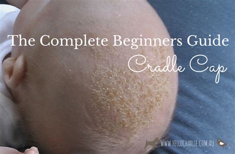 The Complete Beginners Guide To Cradle Cap Cradle Cap Cradle Cap