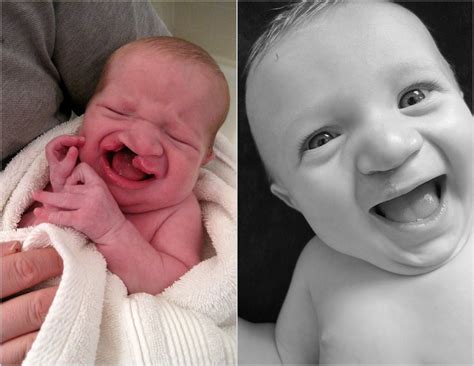 My Baby Before And After Cleft Lip And Palate Surgery Imgur Cleft