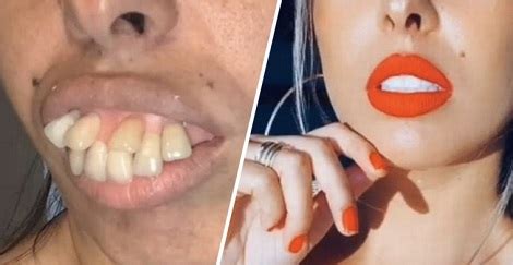 Woman S Teeth Transformation Gets Millions Of Views But Some Spot A