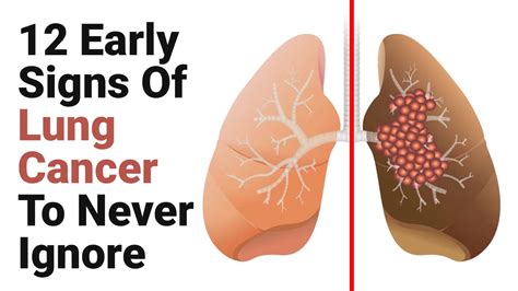 What Are The Early Signs Of Lung Cancer Symptoms Early Sign Of Lung