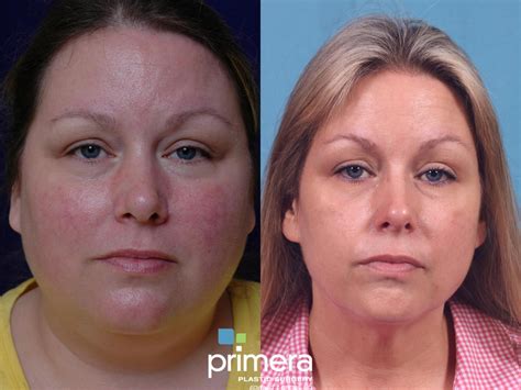 Vbeam Perfecta Pulsed Dye Laser Reviews The Best Picture Of Beam