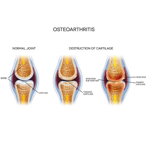 Knee Osteoarthritis Knee Specialist South Windsor Enfield