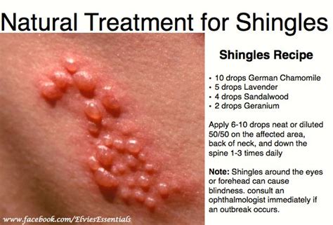 Cynergy Pulsed Dye Laser Natural Treatment For Shingles