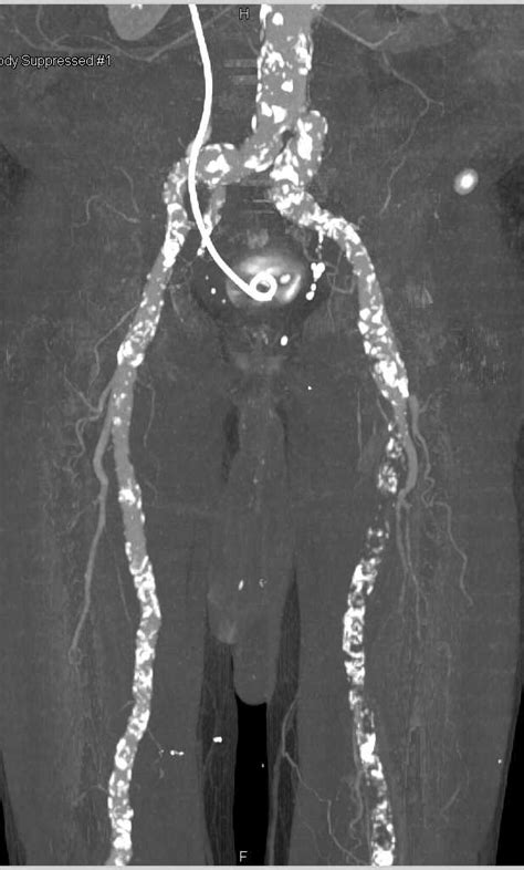 Peripheral Vascular Disease Pvd With Occluded Left Superficial