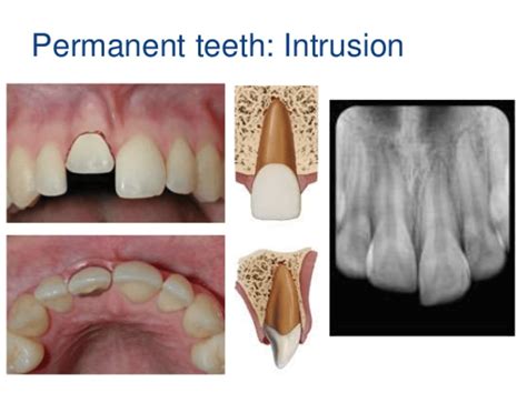 Dental Intrusion News Dentagama
