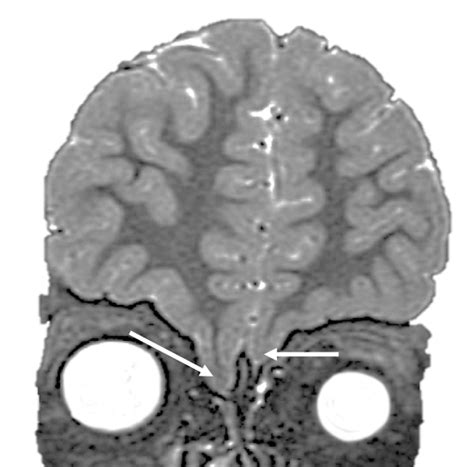 Cribriform Plate In Brain