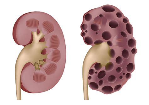 Polykystose Rénale Les Symptômes Le Traitement Et Lalimentation