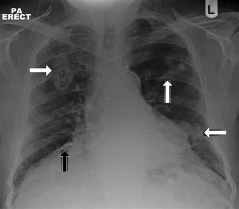Images can provide insights about which treatments might be most effective. What is Mesothelioma Chest X Ray ? - http ...