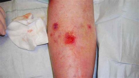 Diabetes Leg Ulcers Help Health