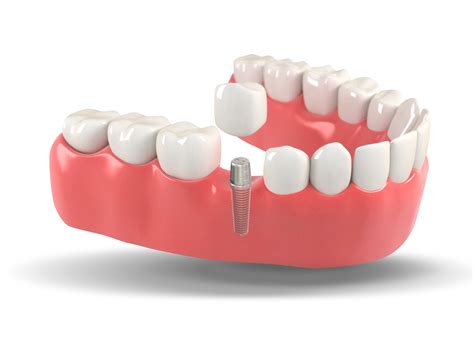 Check spelling or type a new query. dental implants png 20 free Cliparts | Download images on ...