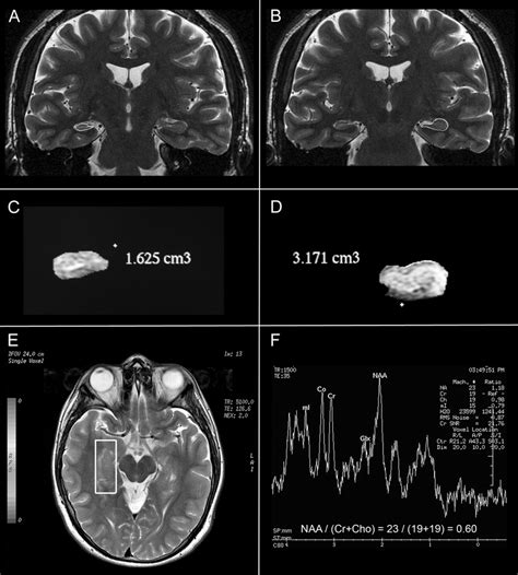 Secondary Mri Findings Volumetric And Spectroscopic Measurements In