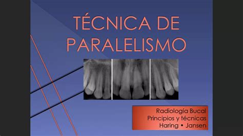 Tecnica De Paralelismo Dental