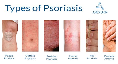 Can Psoriasis Ever Be Cured And Go Away For Good Bella All Natural