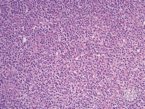 Most people are infected by the virus as children, when the disease produces few or no symptoms. Ruptured spleen due to infectious mononucleosis - 3.