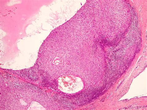 Pathology Outlines Angiomatoid Fibrous Histiocytoma