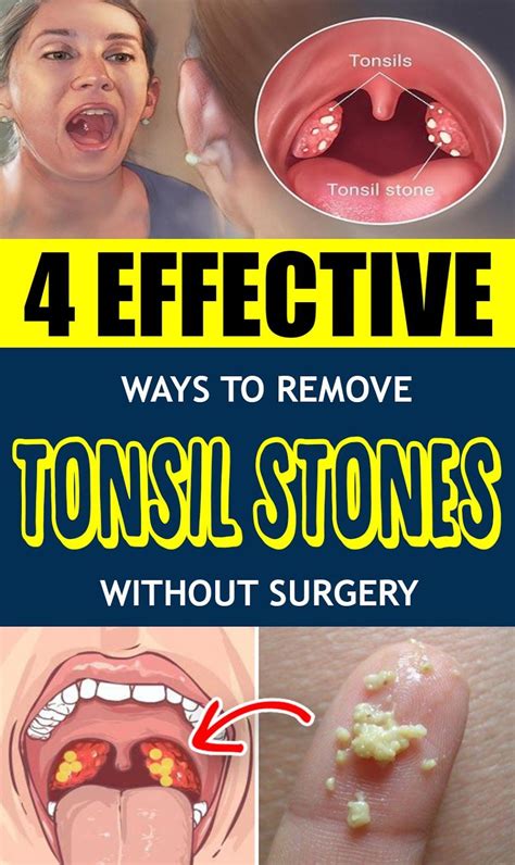 4 Effective Ways To Remove Tonsil Stones Without Surgery