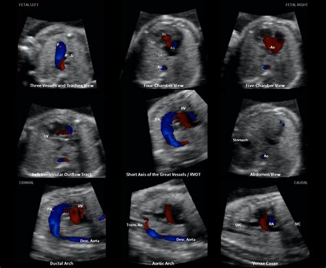 Prenatal Diagnosis Of Hypoplastic Left Heart And Coarctation Of The