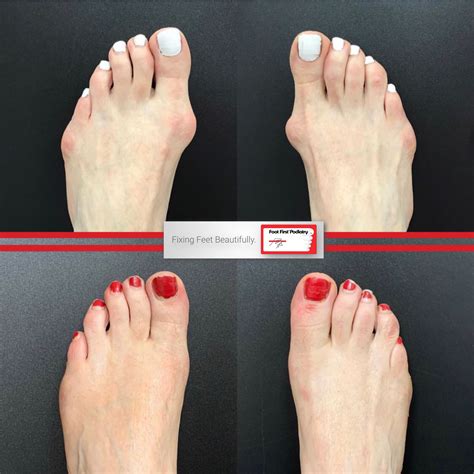 Bunion On Both Sides And Both Feet No Problem We Can Fix Both