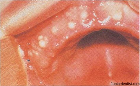 It is a superficial cyst in the alveolar mucosa. Gingival Cyst of Adults and Newborn