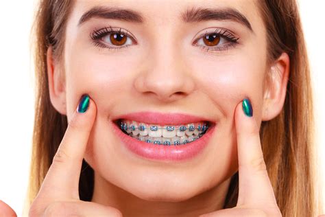 Woman smiling showing teeth with braces | Brodsky Orthodontics