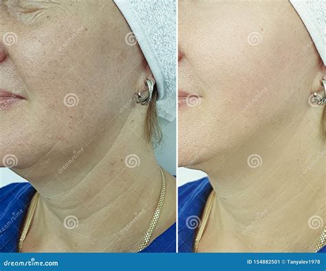 Woman Wrinkles Face Swollen Removal Before Treatment Difference Sagging