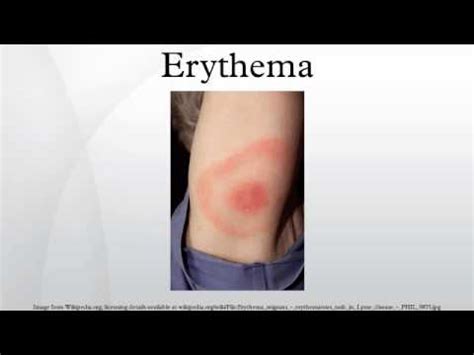 Maybe you would like to learn more about one of these? Erythema Marginatum