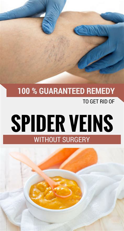 100 Guaranteed Remedy To Get Rid Of Spider Veins Without Surgery