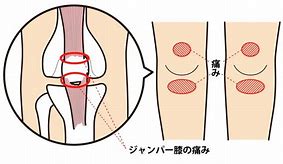 ジャンパー膝 に対する画像結果