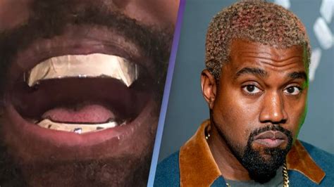Kanye Wests 850000 Titanium Teeth Are ‘permanent And Go ‘beyond