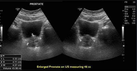 Benign Prostatic Hyperplasia Enlarged Prostate Pedes Oc