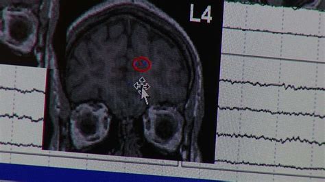 what is epilepsy here s what you need to know about the seizure causing spectrum of disorders cnn